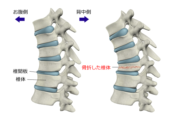 図２　腰椎の圧迫骨折